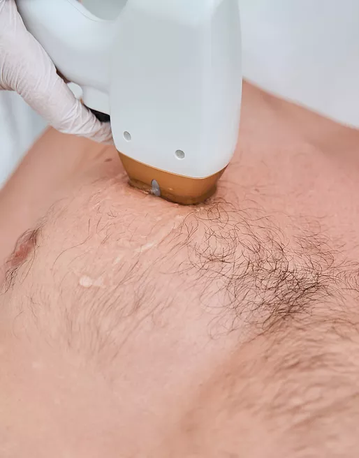 Chest laser hair removal for men