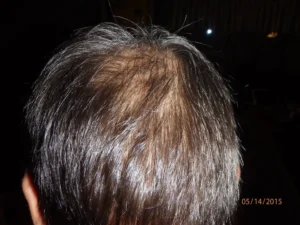 microneedling for hair growth