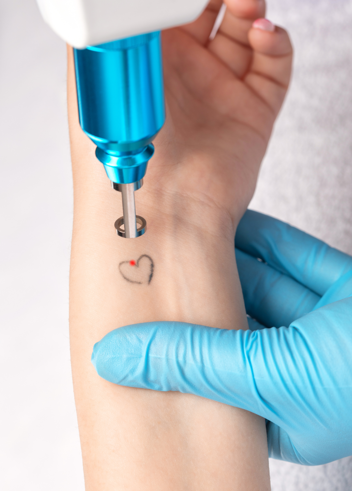 Laser tattoo removal treatment