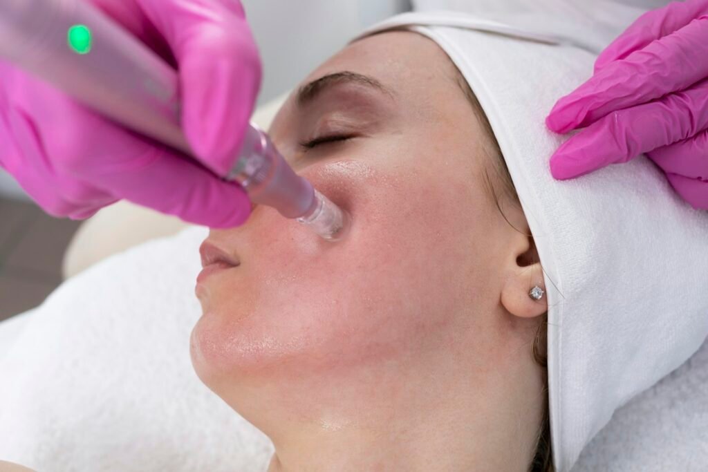Microneedling treatment in progress